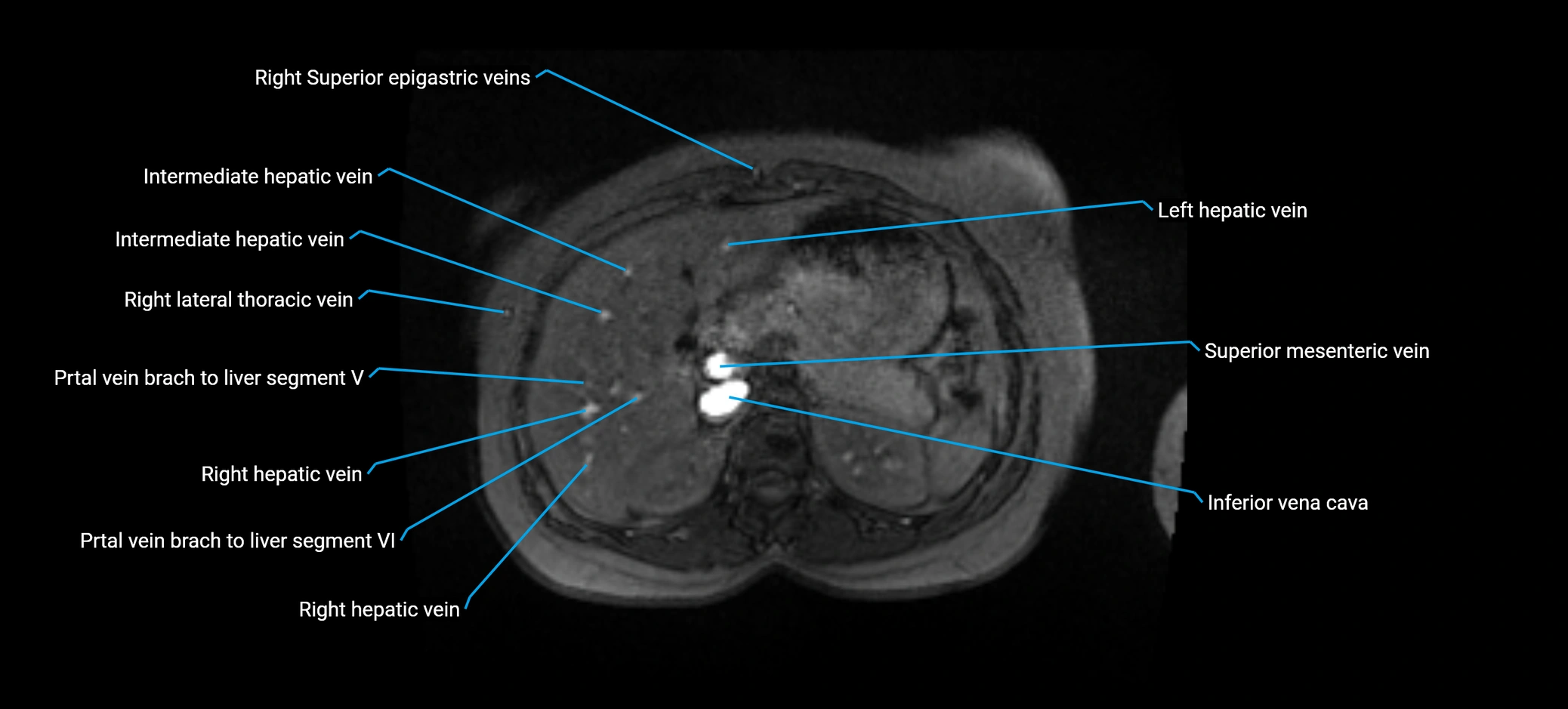 MRV abdomen pelvis & lower limb axial cross sectional anatomy labelled MRI image 48 (1).webp
